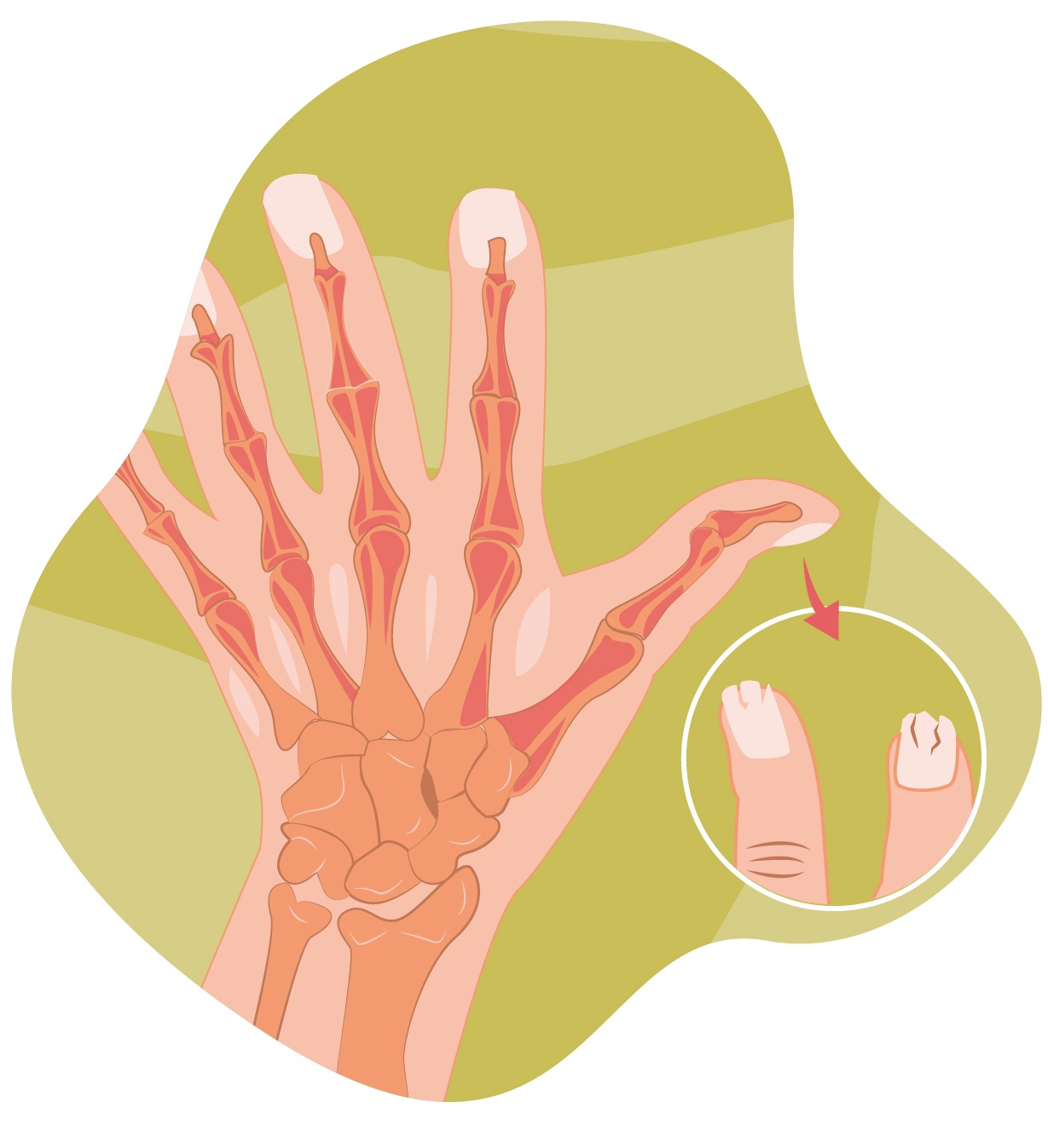 Artritis Psoriásica Síntomas, tratamiento y diagnóstico IMSKE