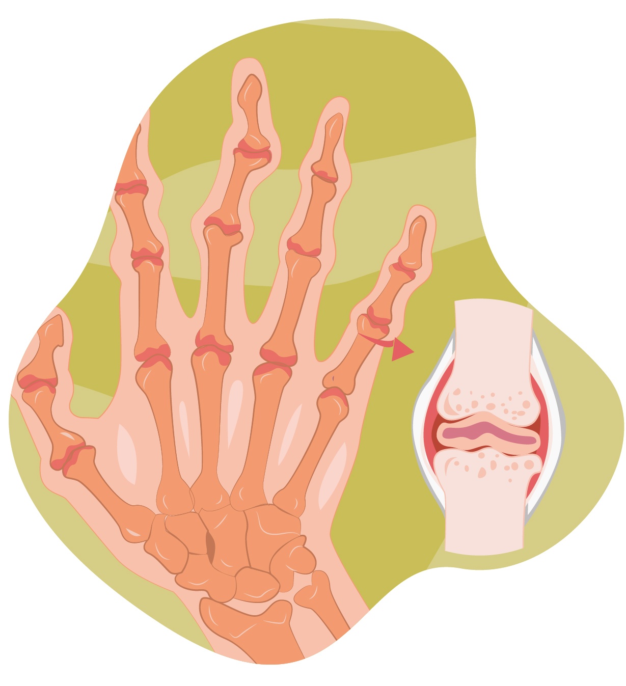 Artritis Reumatoide Síntomas, tratamiento y diagnóstico IMSKE Artritis Reumatoide Síntomas, tratamiento y diagnóstico IMSKE