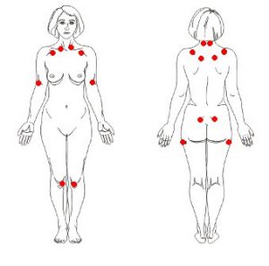 puntos dolorosos fibromialgia