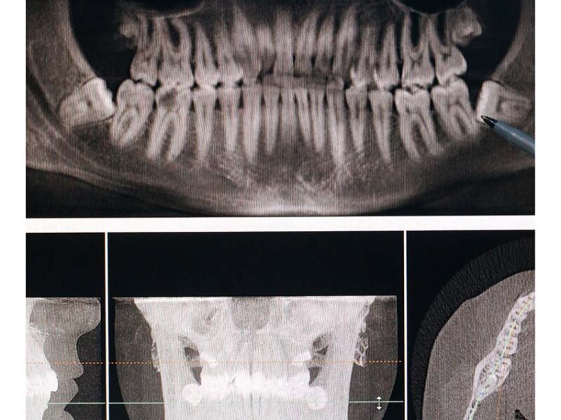 mandibula hospital imske