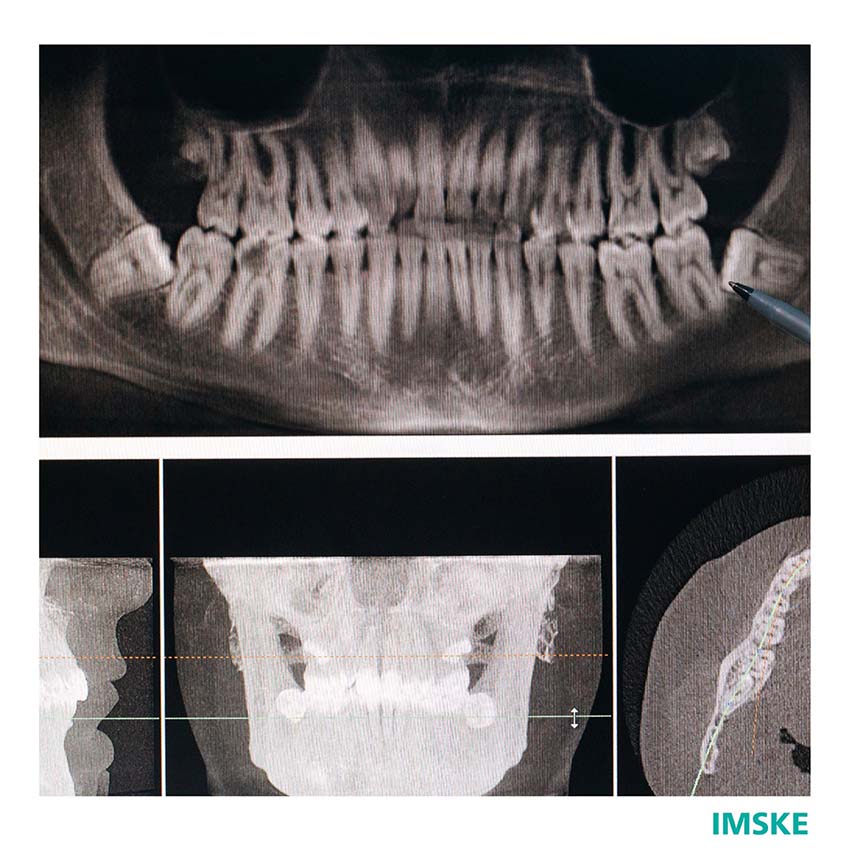 mandibula hospital imske