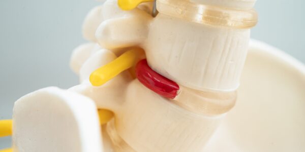 Lumbar spine displaced herniated disc fragment, spinal nerve and bone. Model for treatment medical in the orthopedic department.