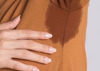 hiperhidrosis Hiperhidrosis o sudoración excesiva