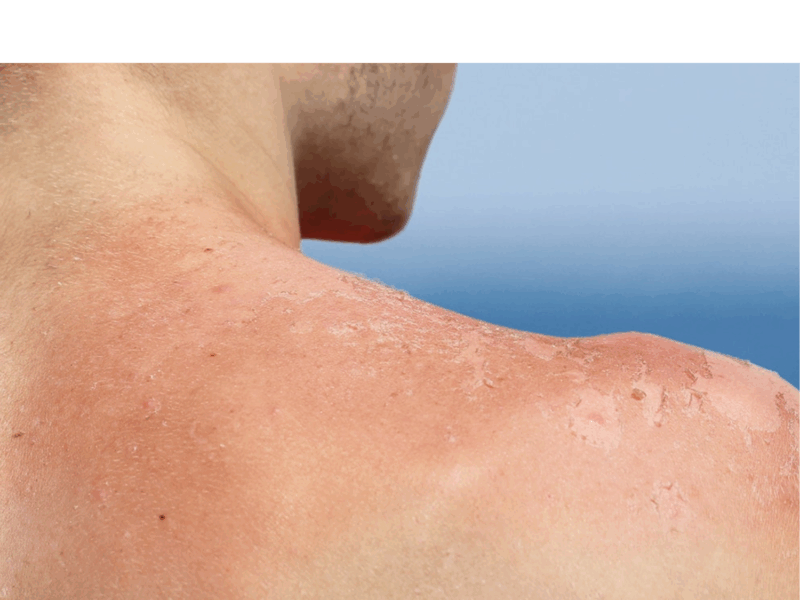 Revisión dermatológica de manchas solares tras el verano en Ribera Mestalla